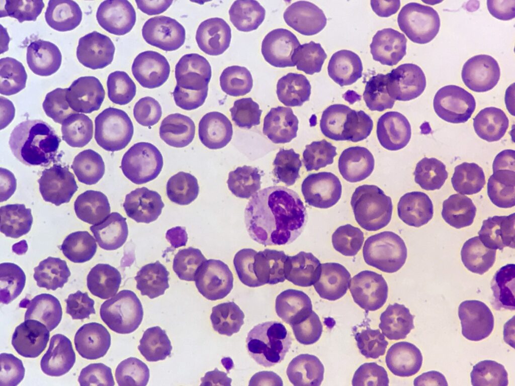 Canine Distemper Virus Cytoplasmic Inclusion Body Blood smear Wrights stain